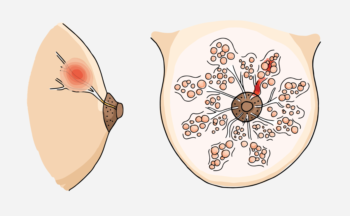Drawing of breast anatomy including a clogged milk duct